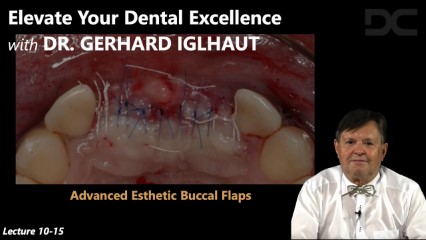 Advanced esthetic buccal flaps